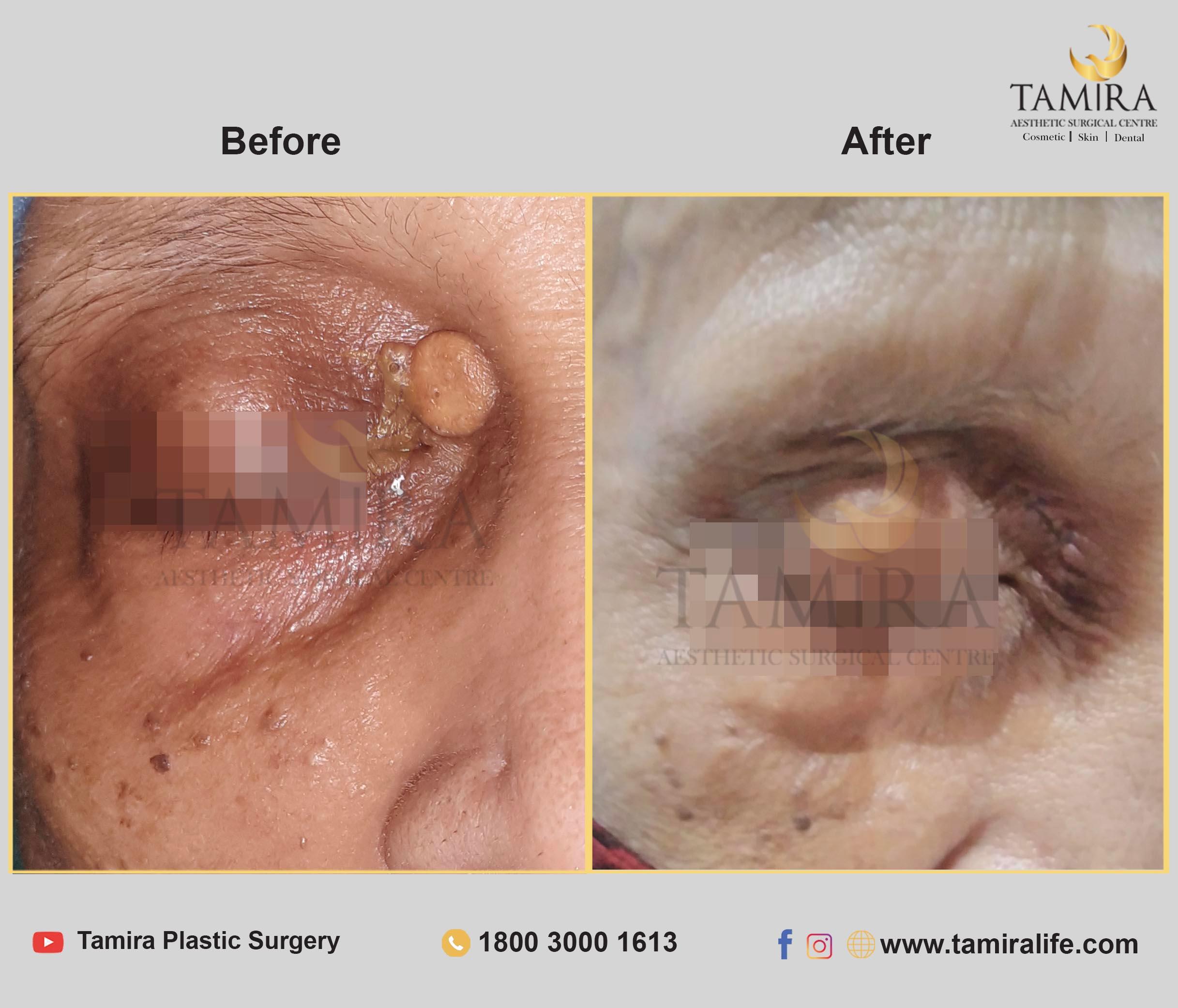 Sebaceous Cyst Excision - Before & After