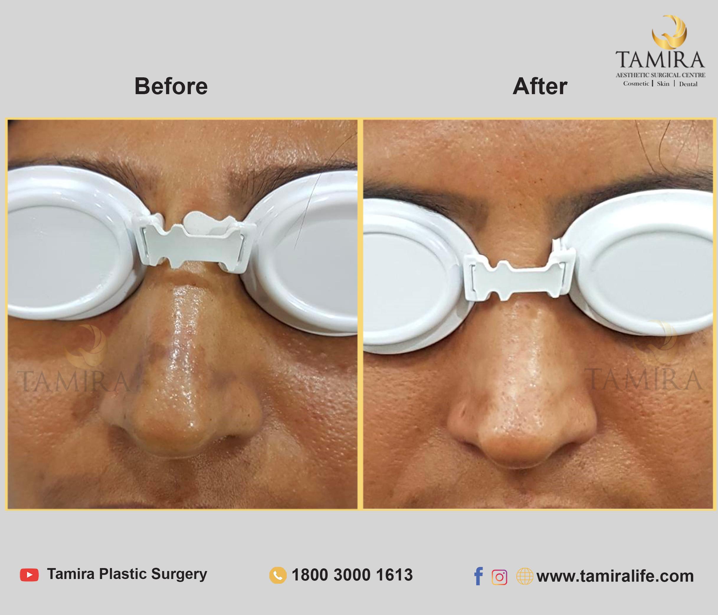 Microneedling - Before & After