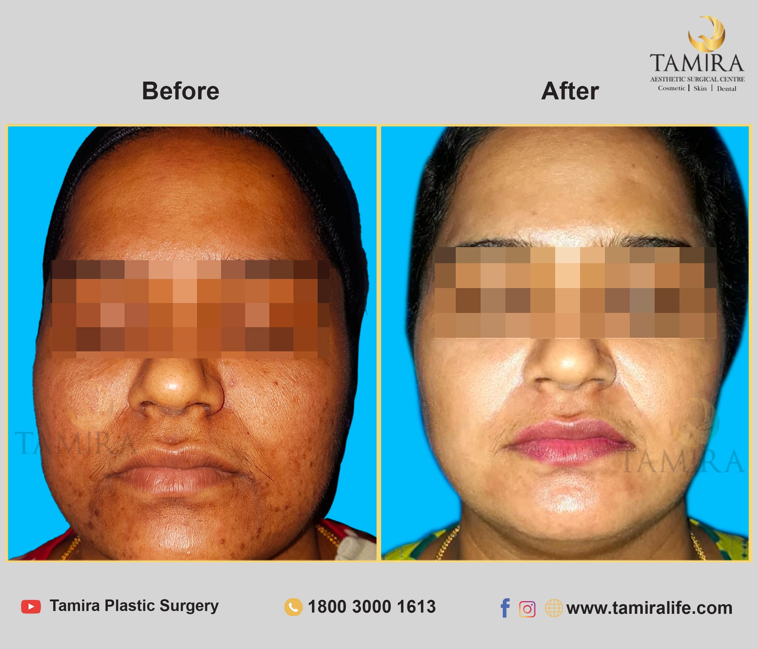 Microneedling - Before & After