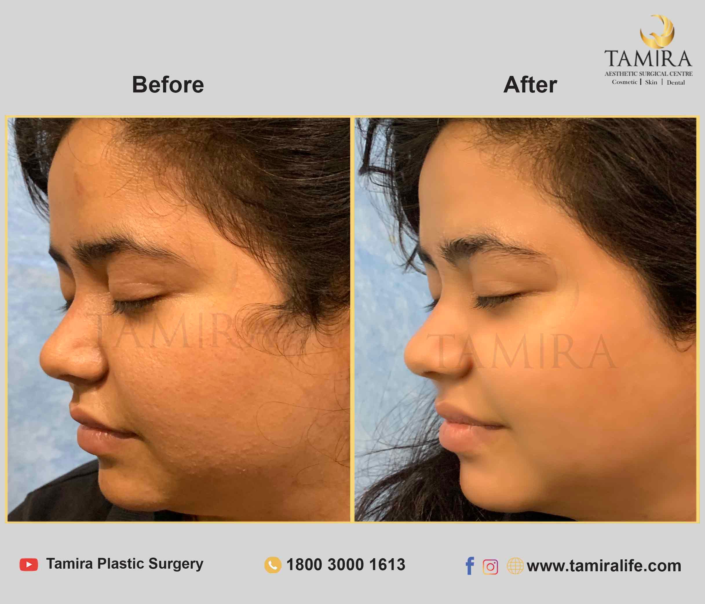 Hydra Facial - Before & After
