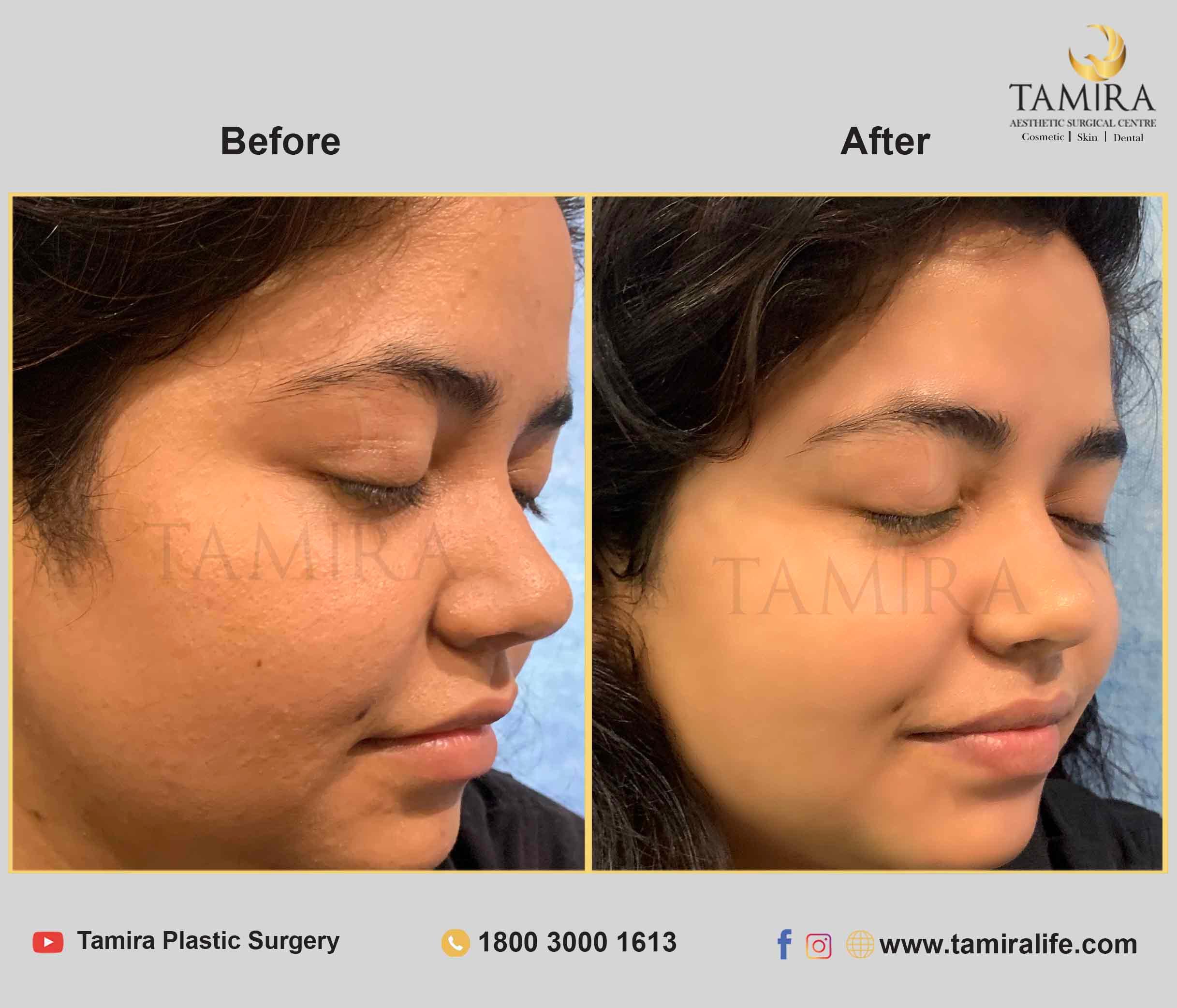 Hydra Facial - Before & After