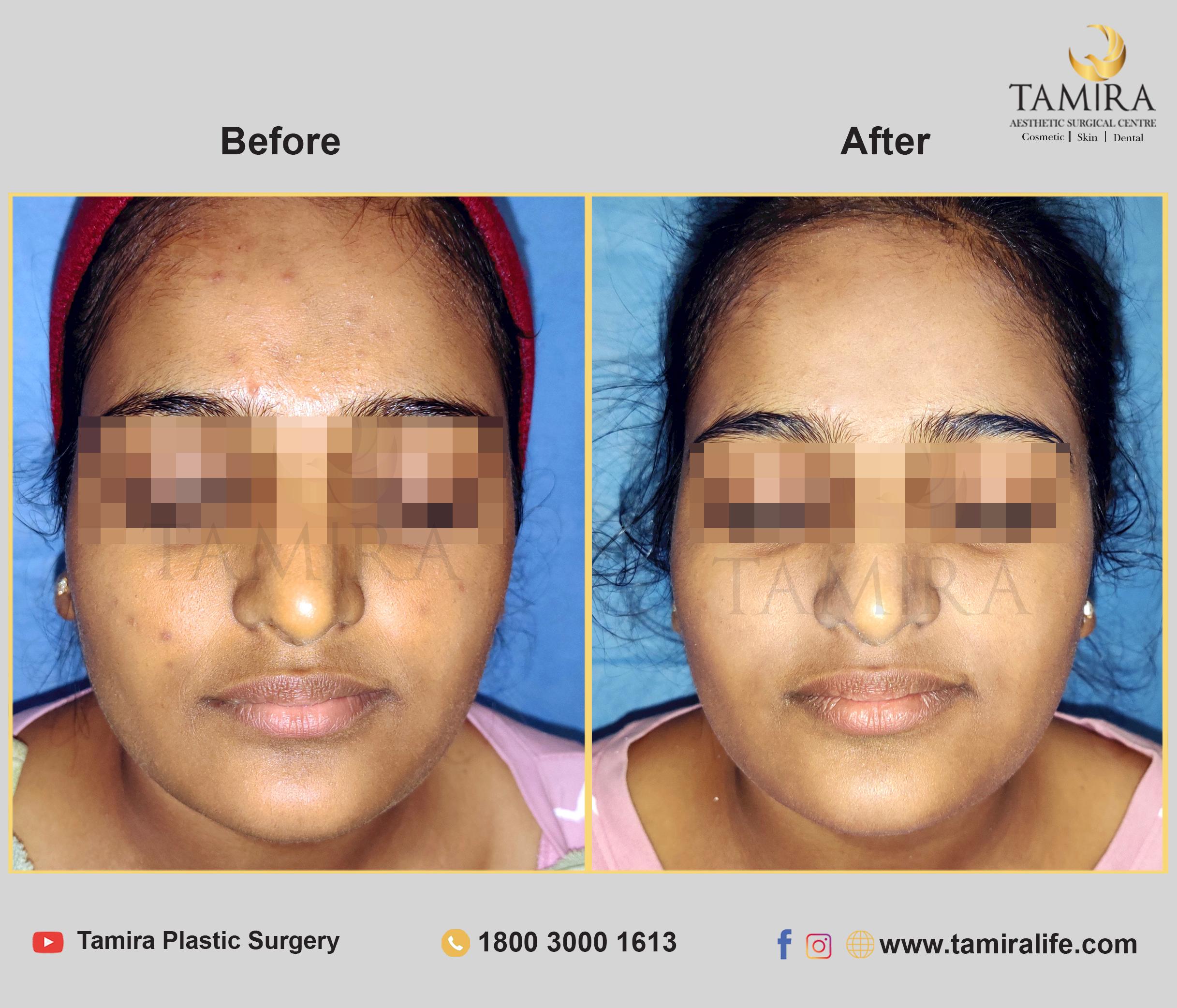 Hydra Facial - Before & After