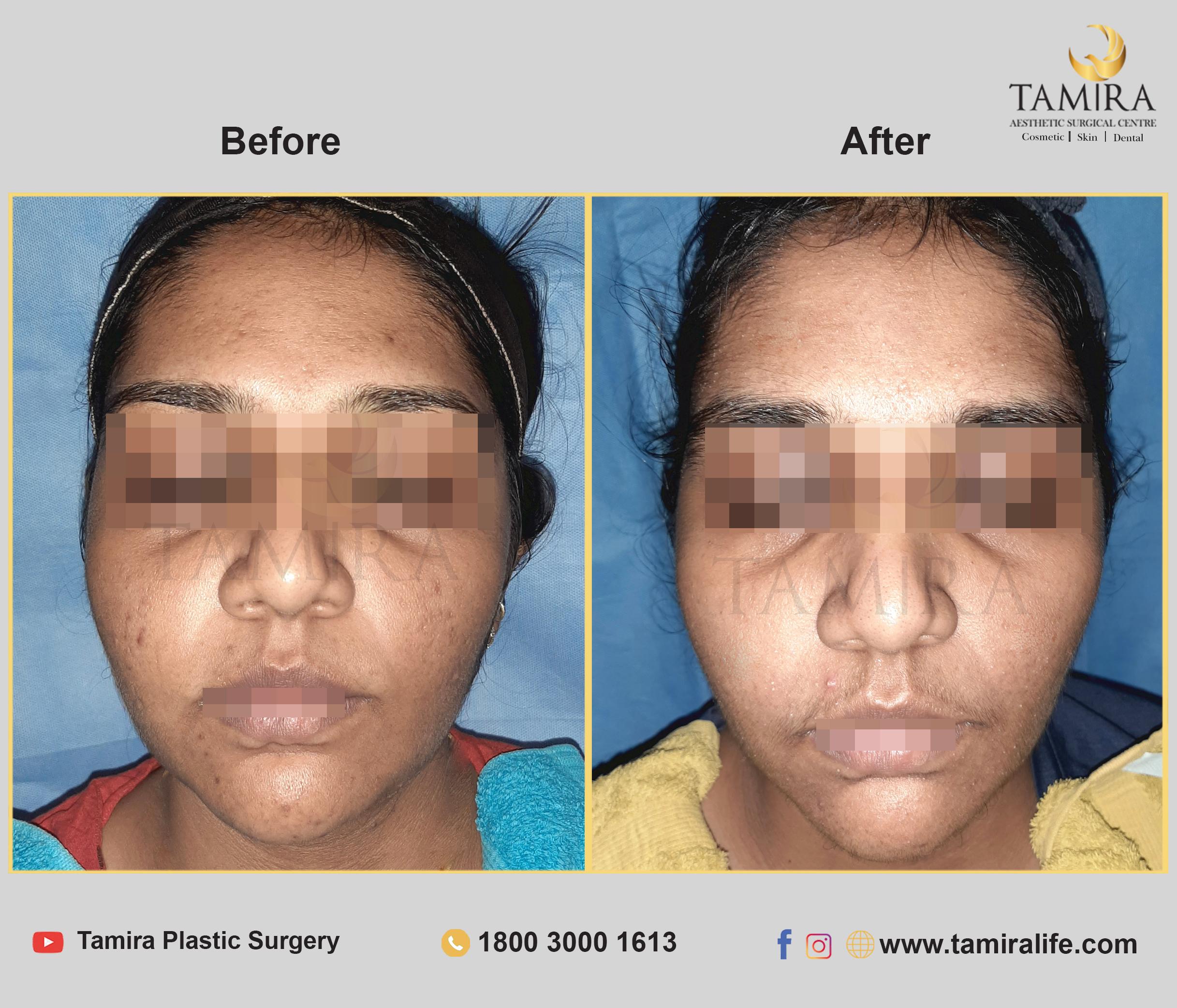 Hydra Facial - Before & After