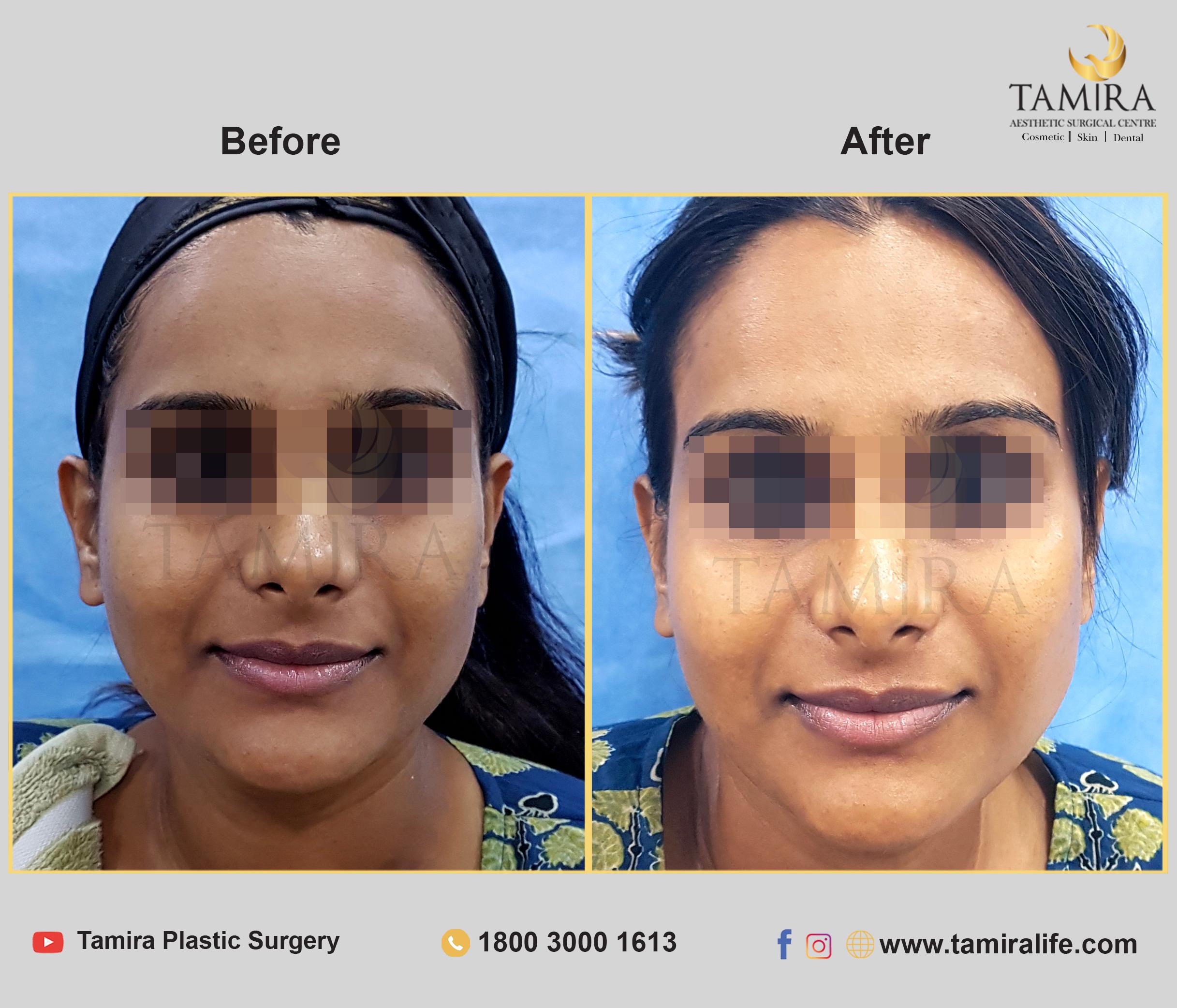 Hydra Facial - Before & After