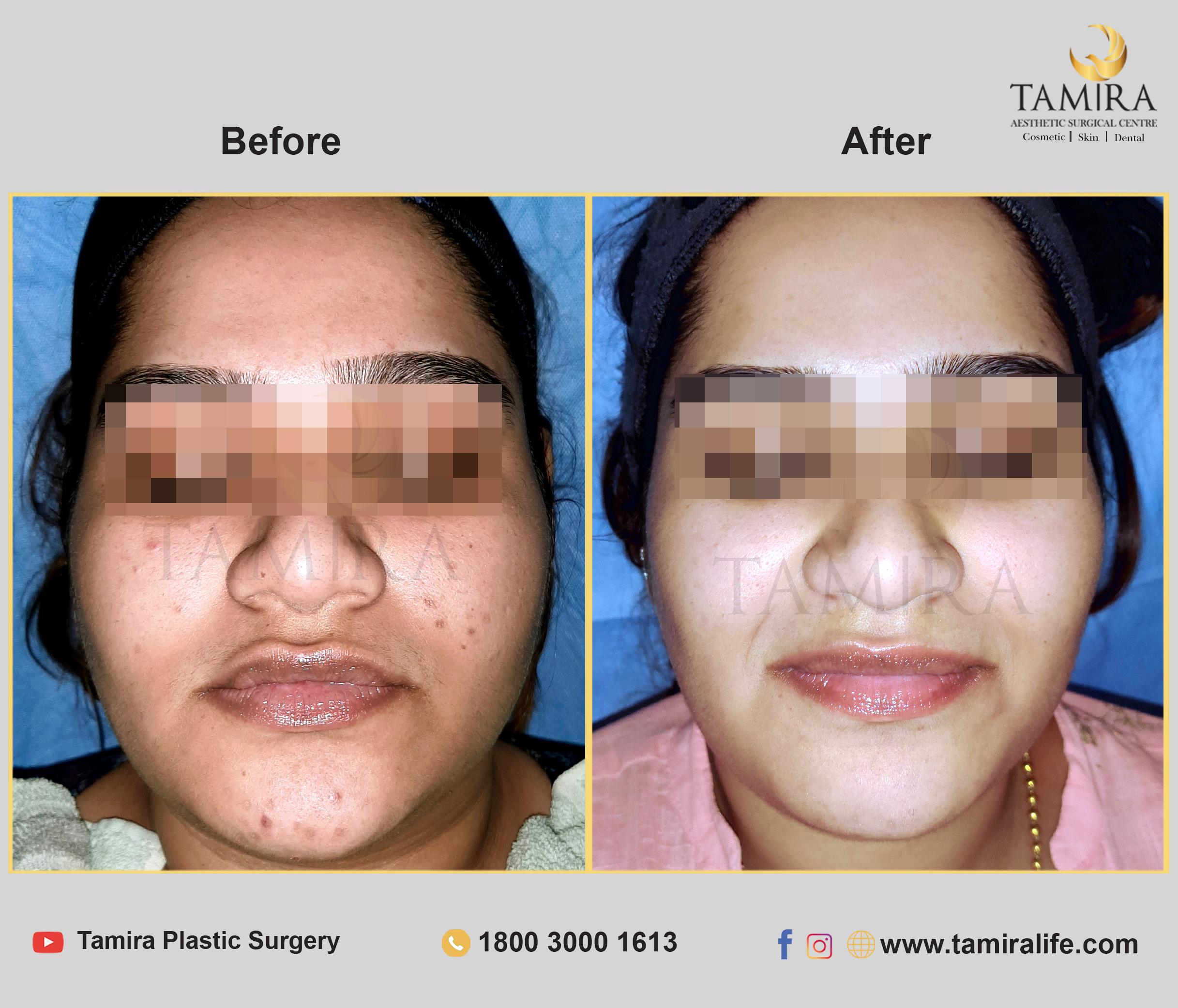 Hydra Facial - Before & After