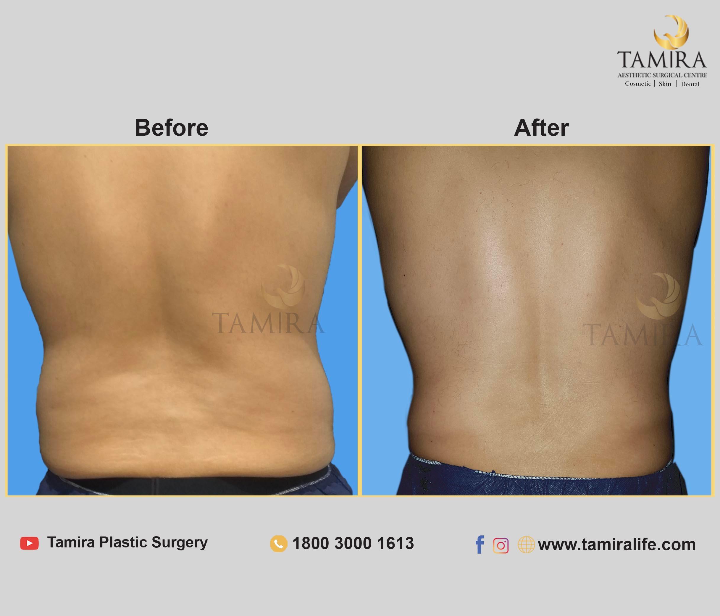 Coolsculpting - Before & After