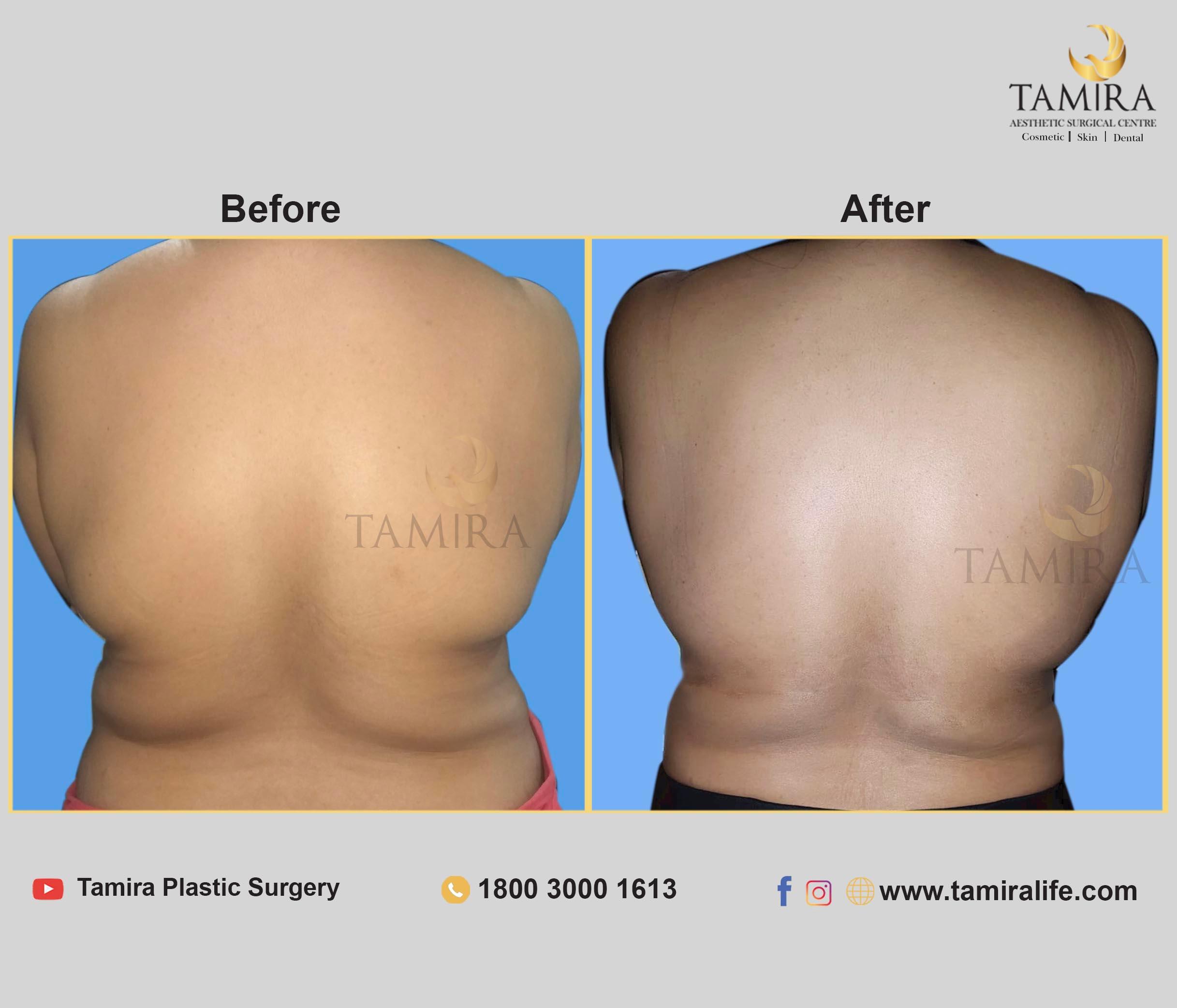 Coolsculpting - Before & After