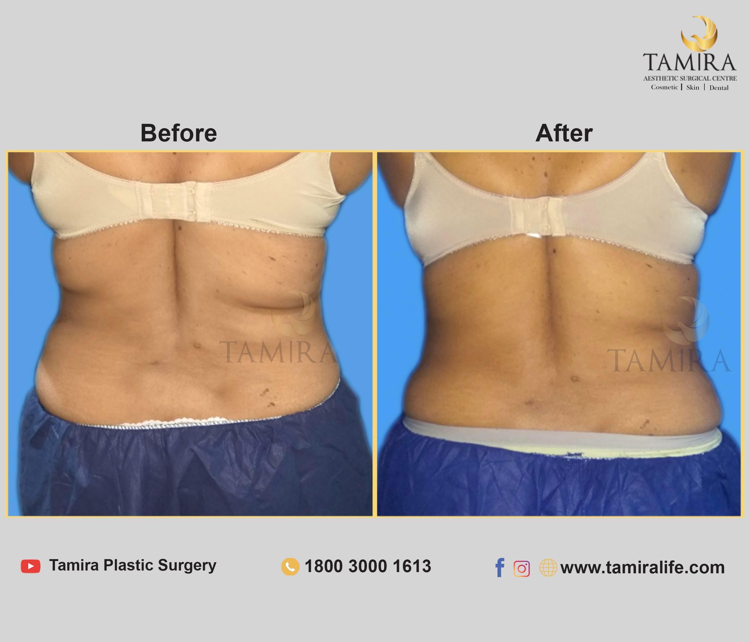 Coolsculpting - Before & After