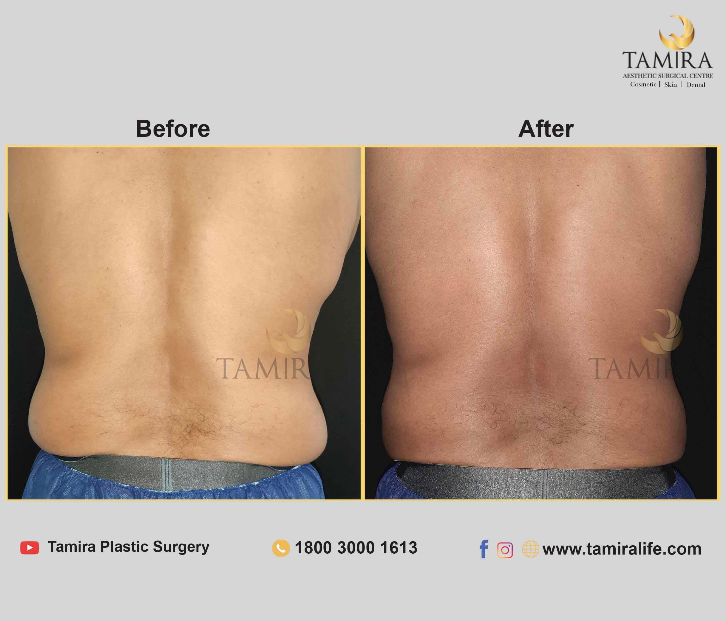 Coolsculpting - Before & After