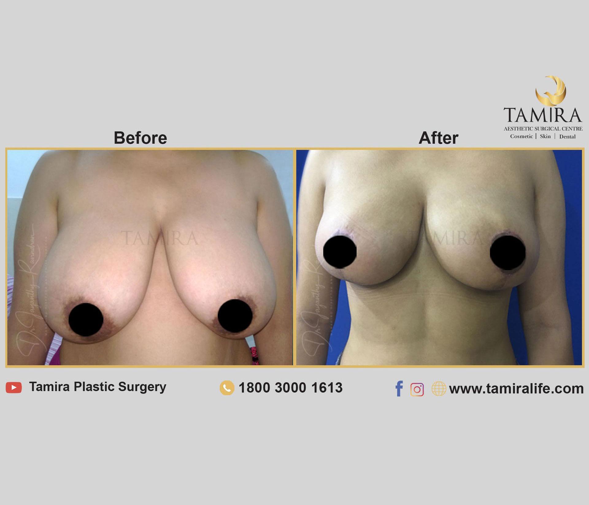 Breast Reduction Surgery or Reduction Mammoplasty - Before & After