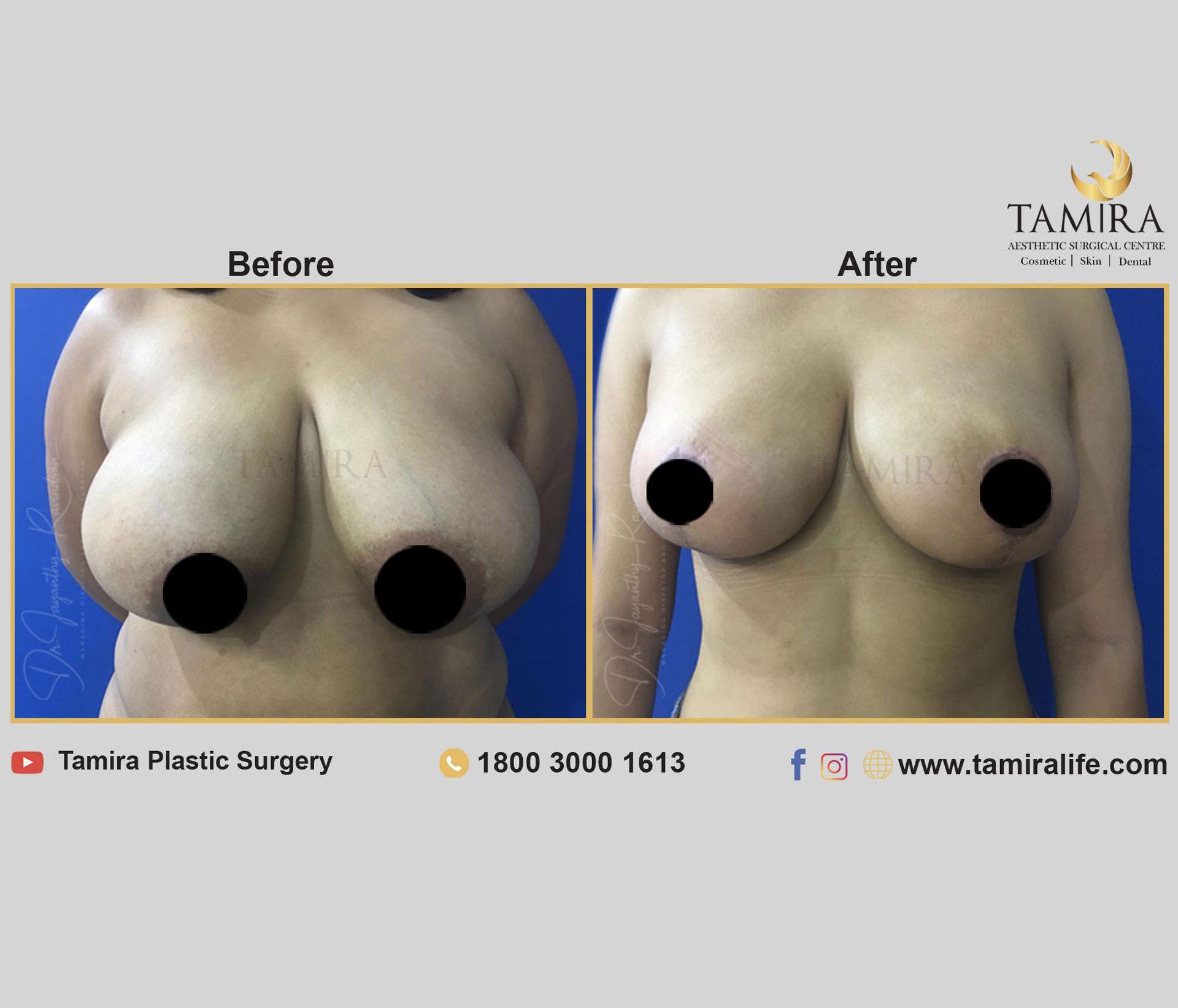 Breast Reduction Surgery or Reduction Mammoplasty - Before & After