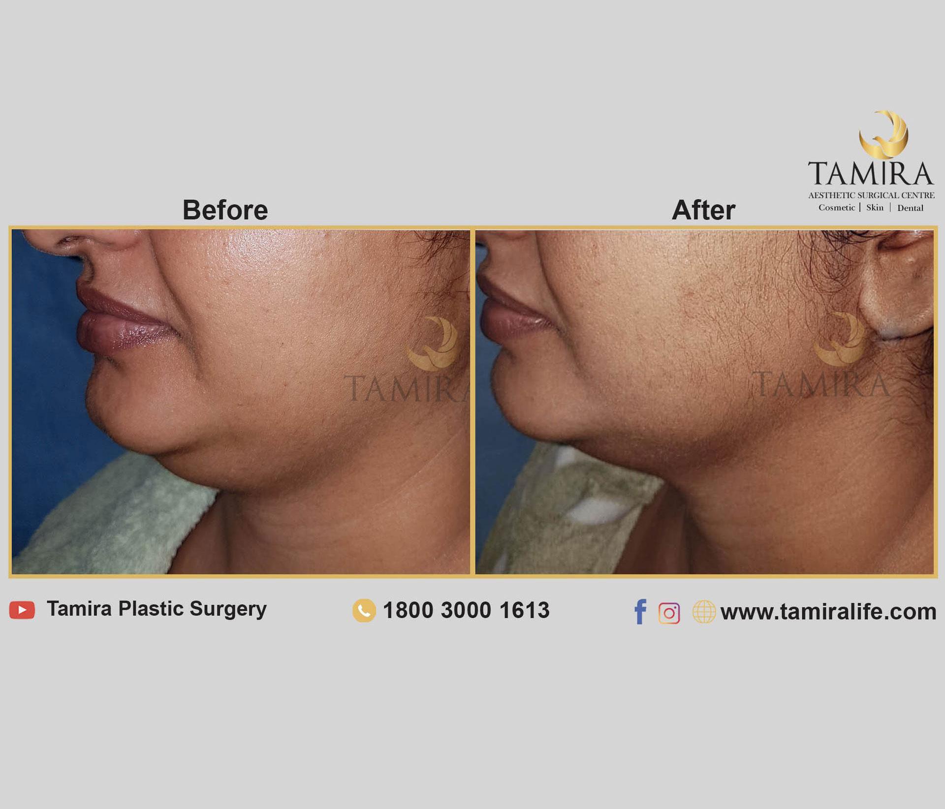 Coolsculpting - Before & After