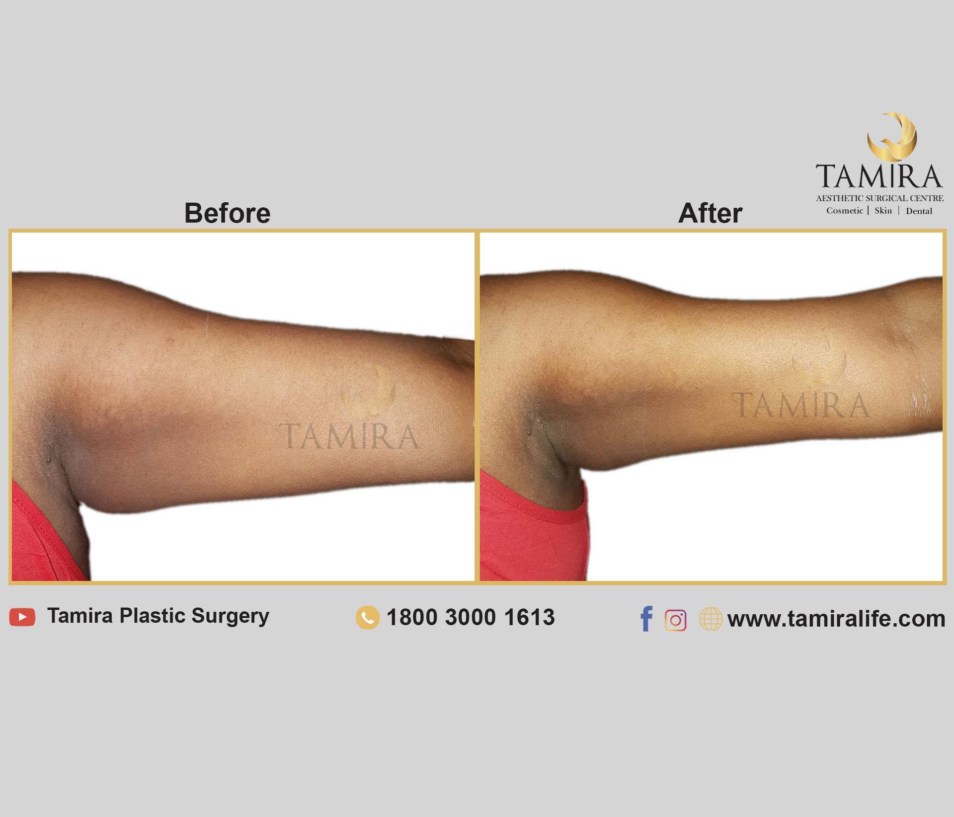 Coolsculpting - Before & After