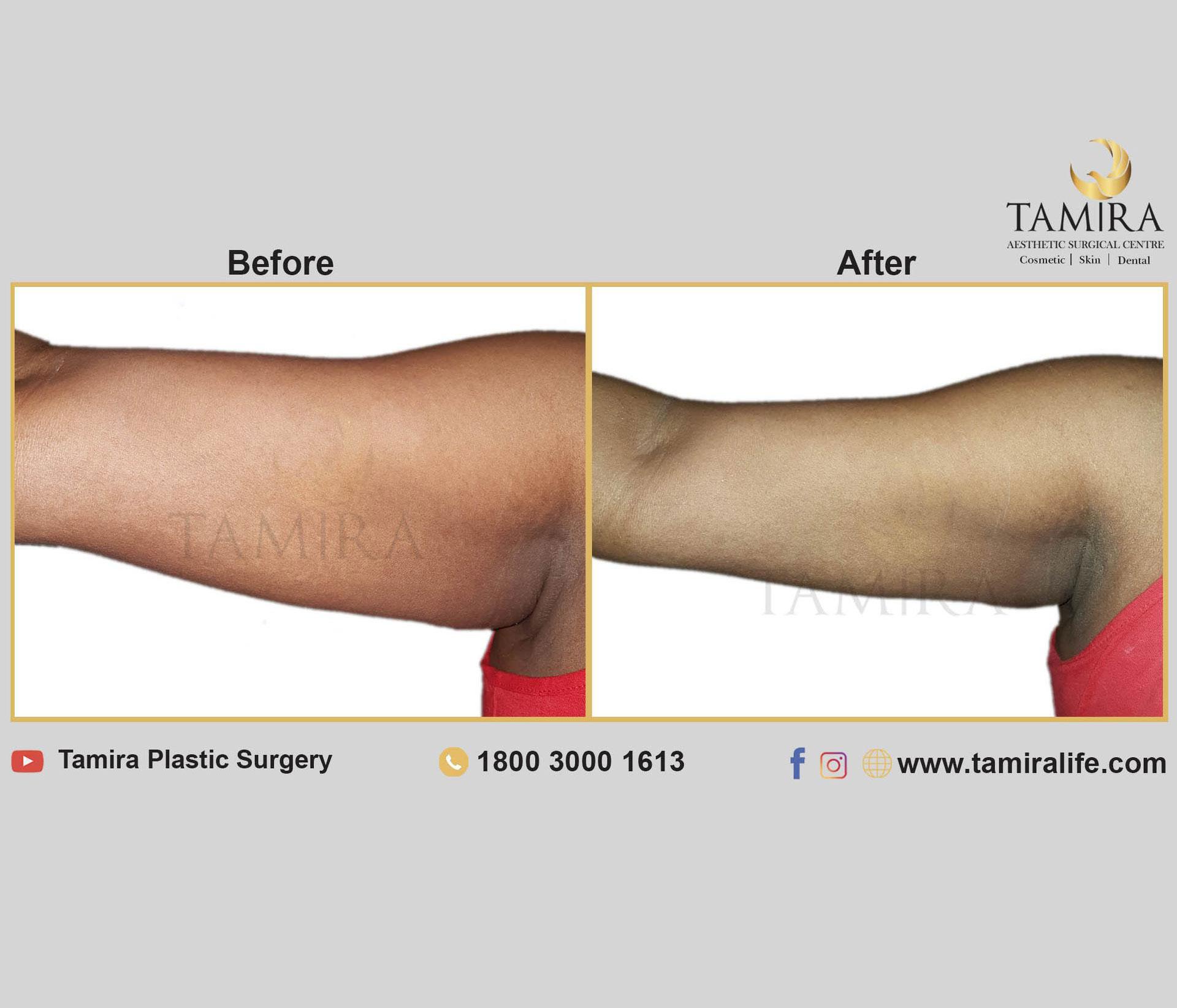 Coolsculpting - Before & After