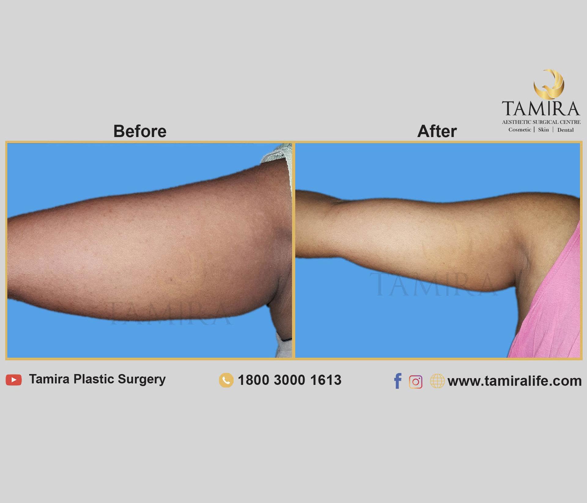 Coolsculpting - Before & After