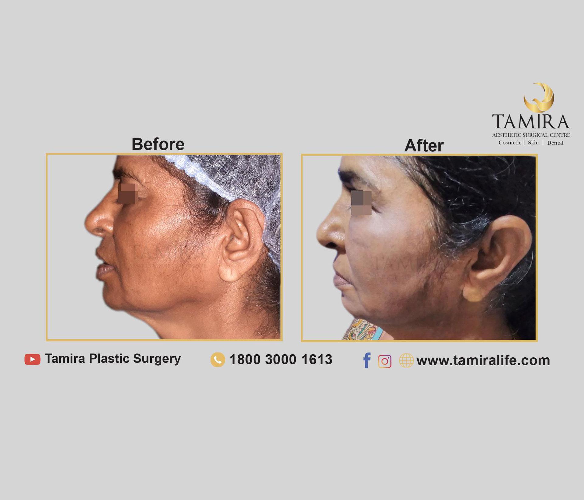 Invasive RF Skin tightening (Facetite/ Accutite / Necktite) - Before & After