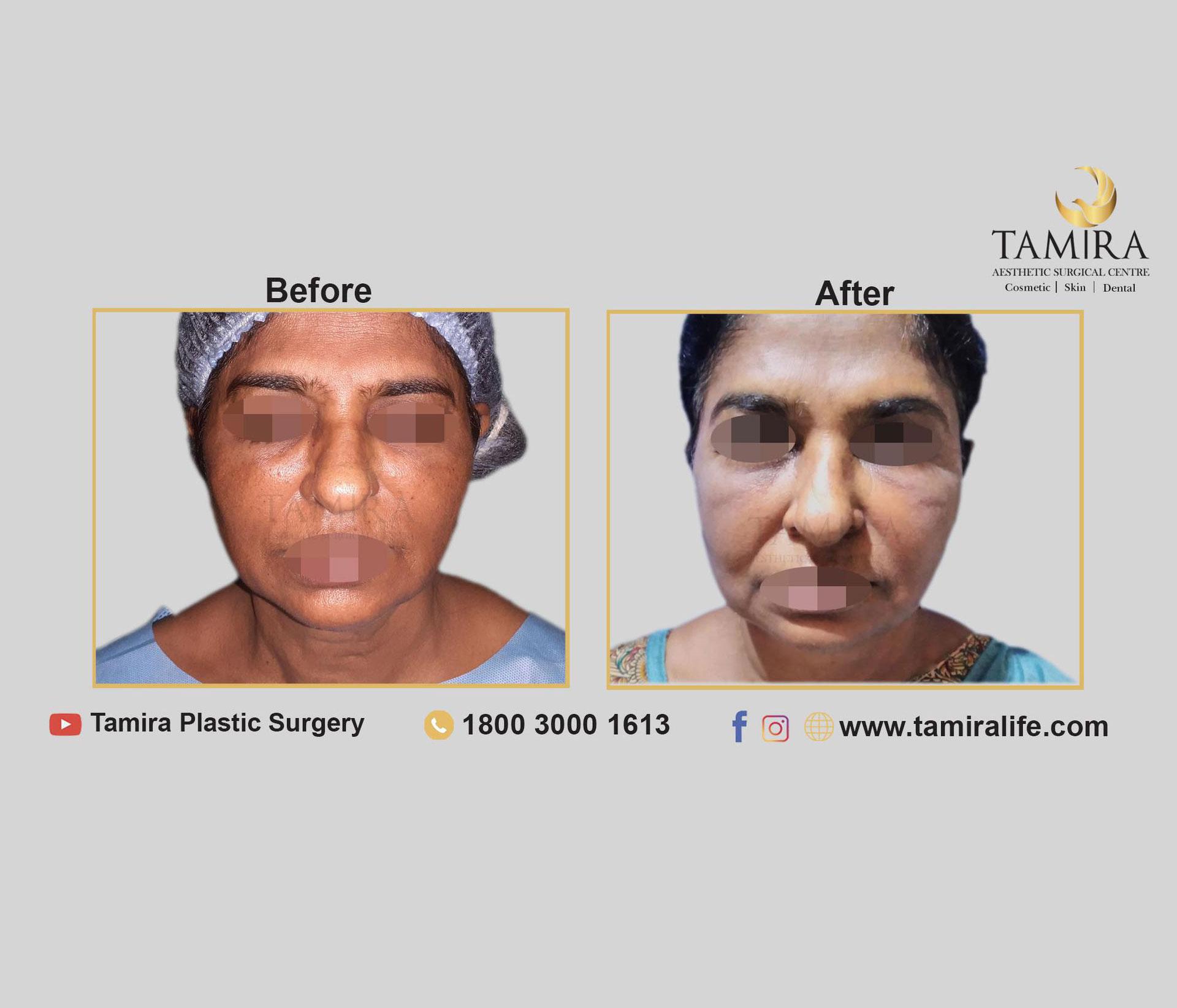 Invasive RF Skin tightening (Facetite/ Accutite / Necktite) - Before & After
