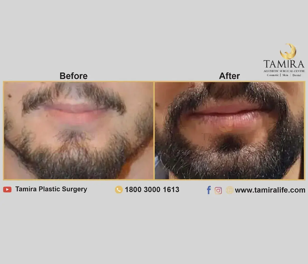 Beard Transplant - Before & After