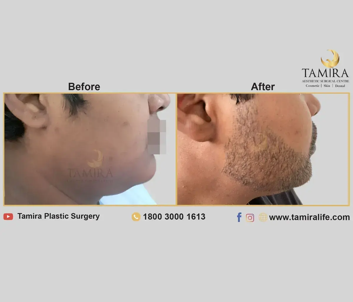 Beard Transplant - Before & After