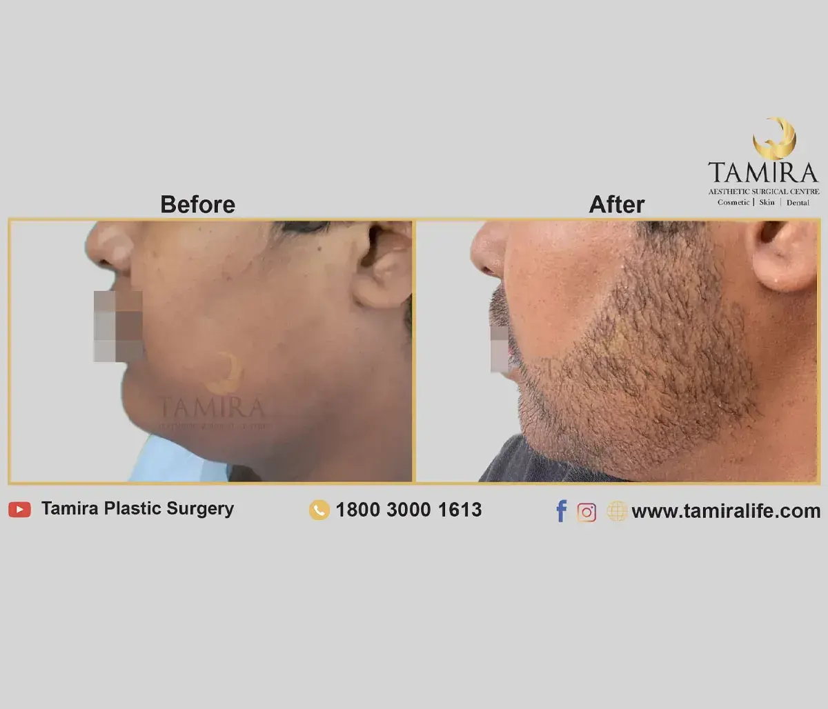 Beard Transplant - Before & After