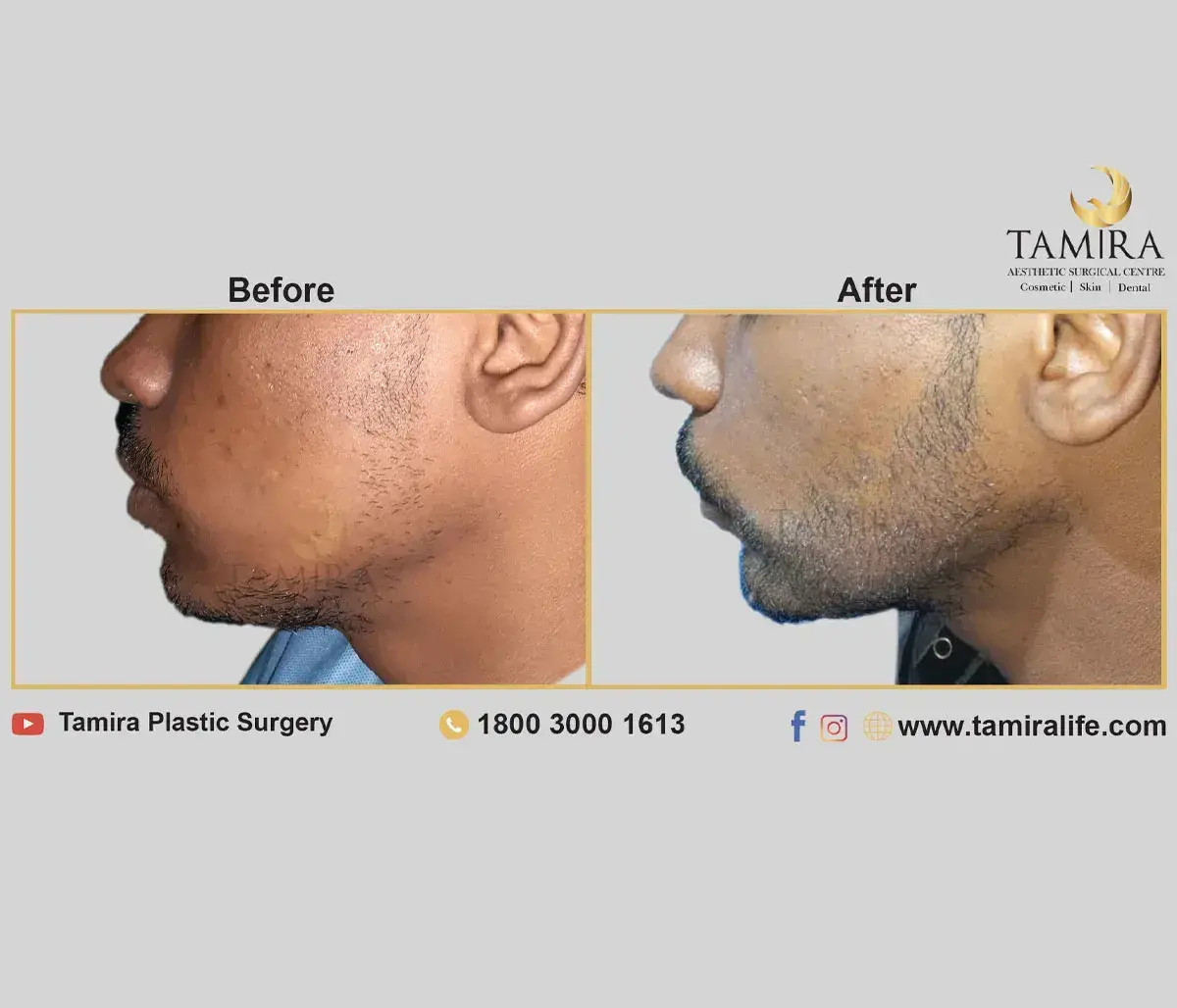 Beard Transplant - Before & After