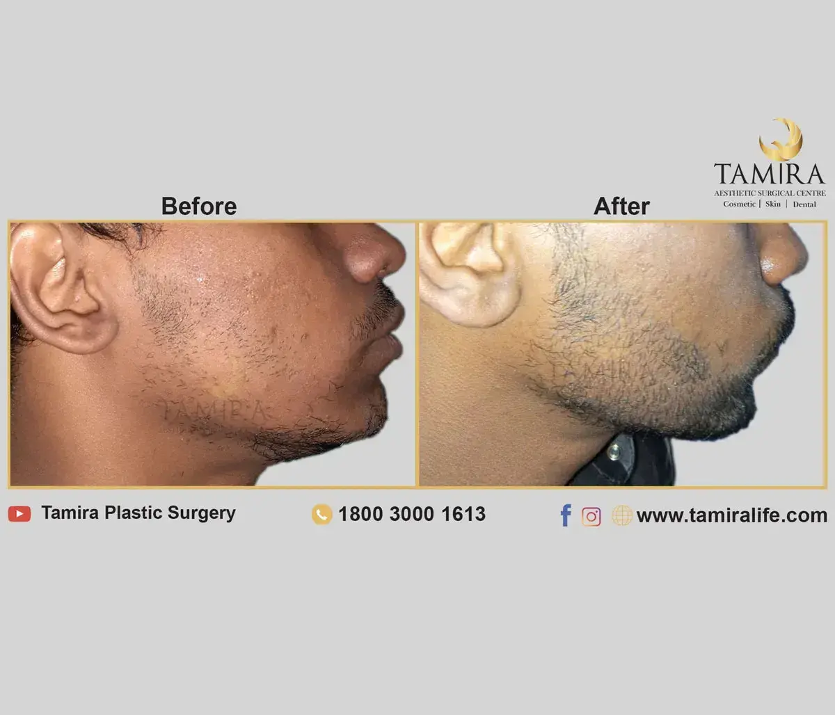 Beard Transplant - Before & After