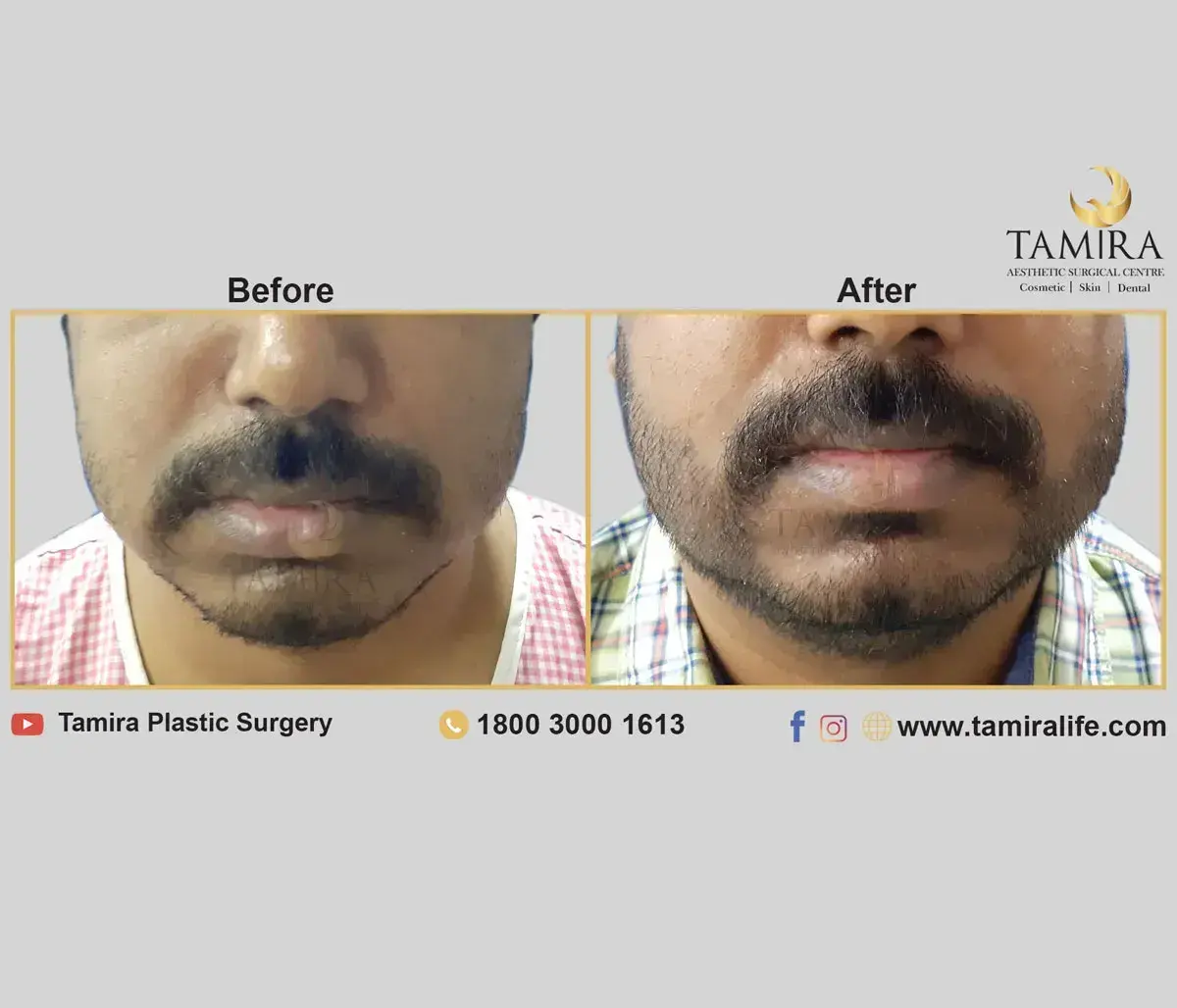 Beard Transplant - Before & After