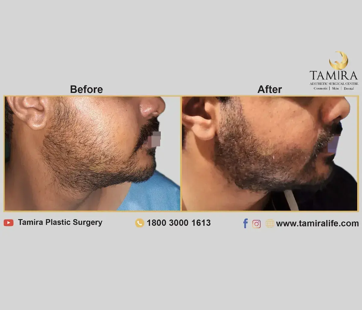 Beard Transplant - Before & After