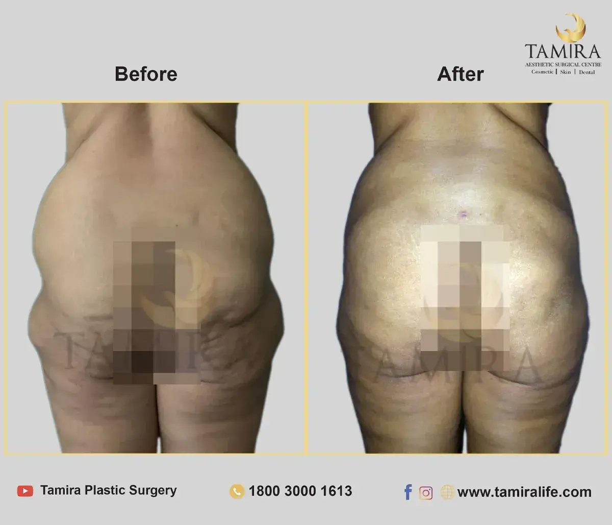 Buttock Augmentation - Before & After
