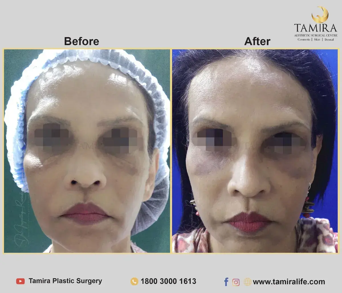 Facelift Surgery with Fat Grafting - Before & After