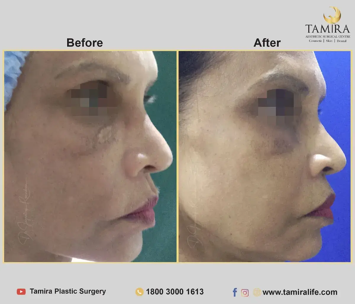 Facelift Surgery with Fat Grafting - Before & After