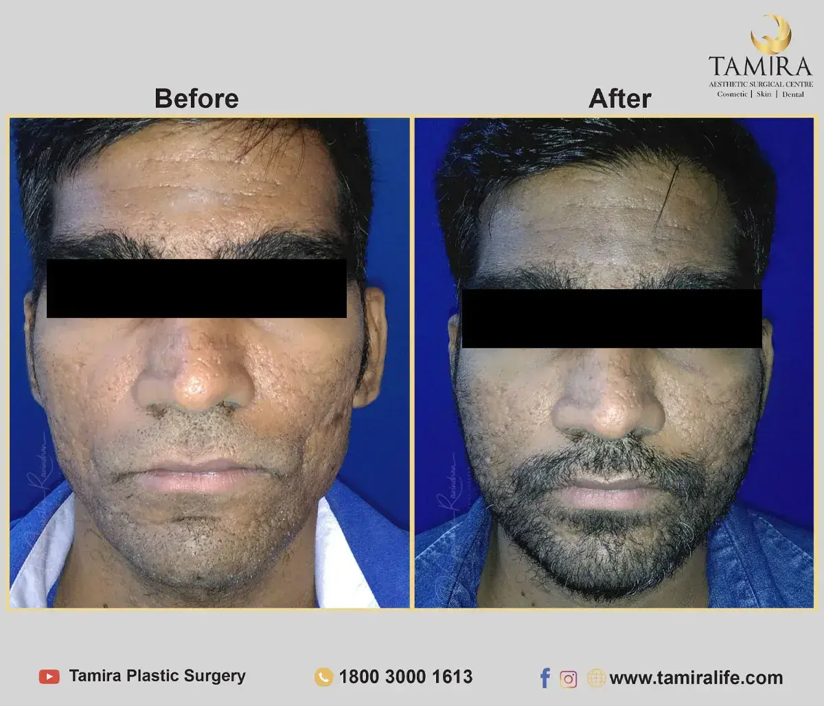 Facelift Surgery with Fat Grafting - Before & After
