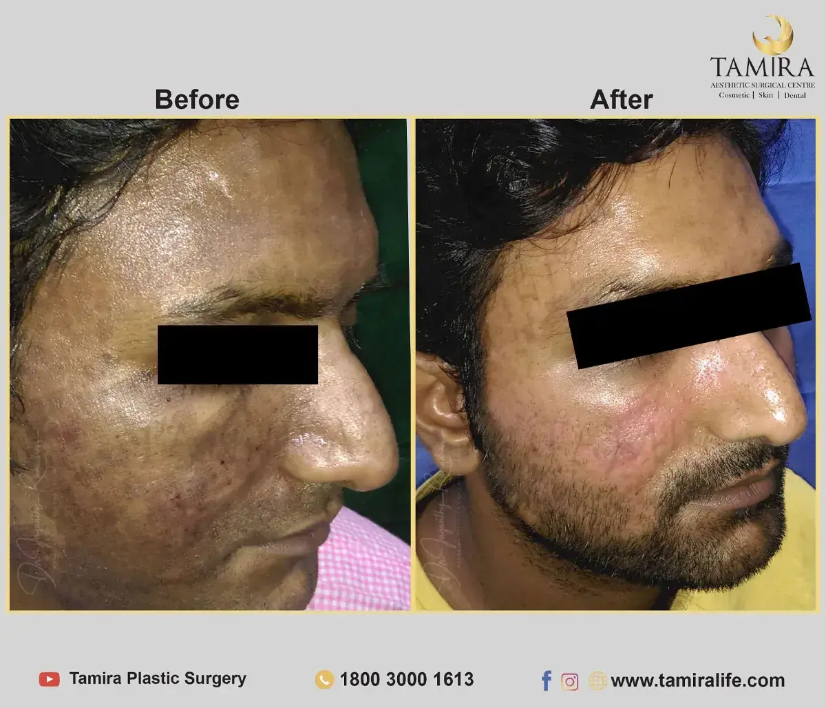 Facelift Surgery with Fat Grafting - Before & After