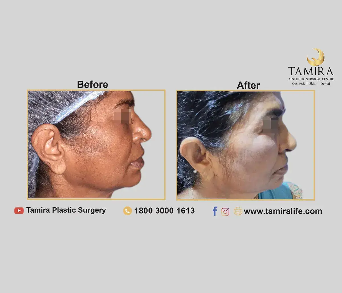 Invasive Radio Frequency - Inmode Facetite - Face - Before & After