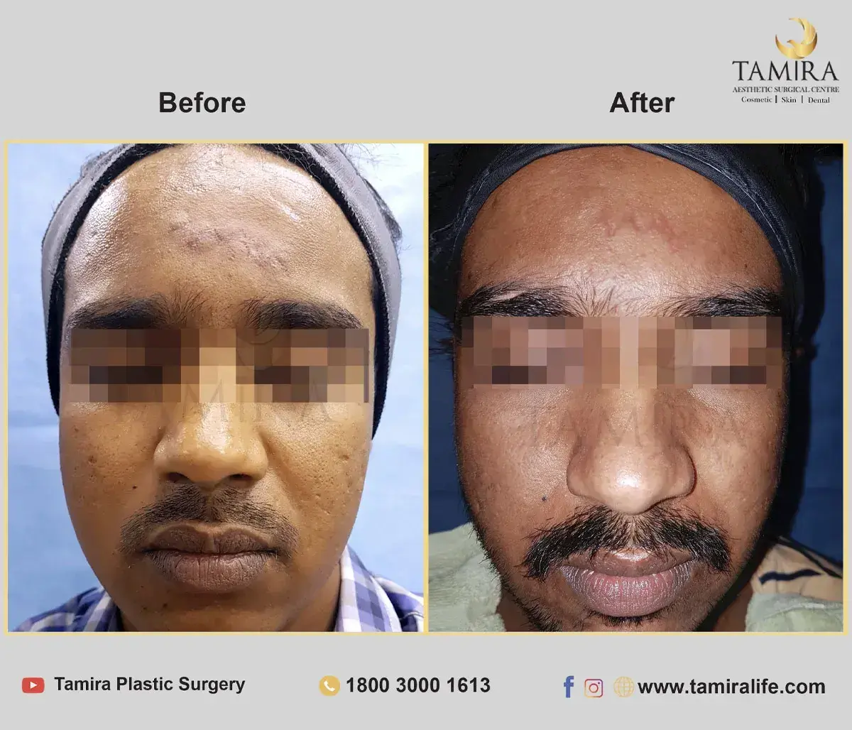 Laser treatment - Skin - Before & After