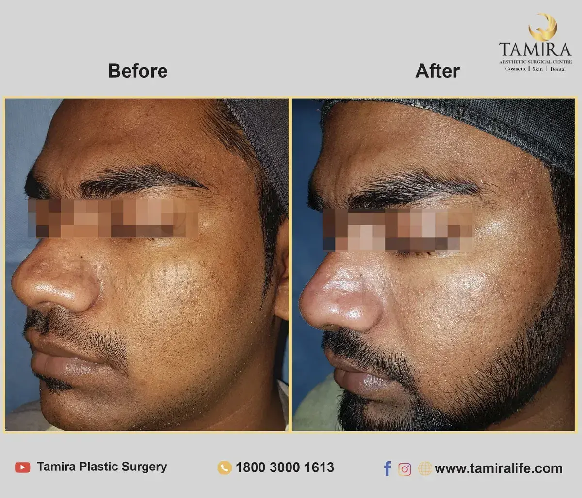 Laser treatment - Skin - Before & After