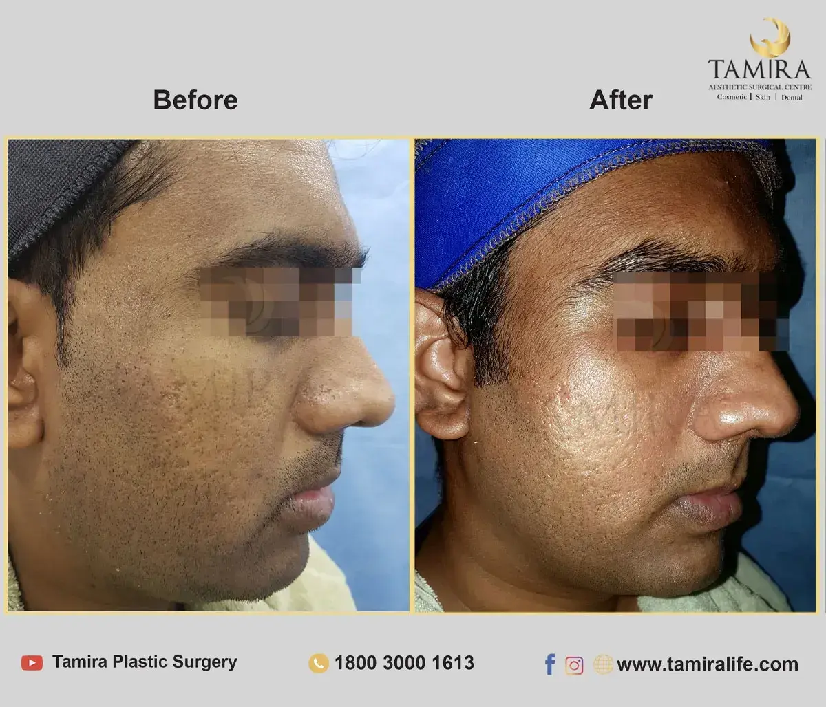 Laser treatment - Skin - Before & After