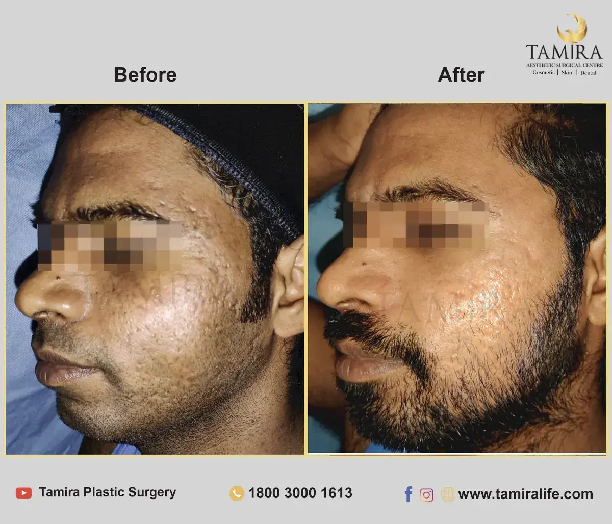 Laser treatment - Skin - Before & After