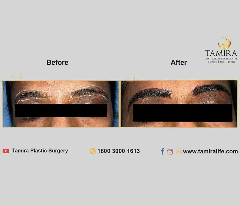 Microblading - Eye Brows - Before & After