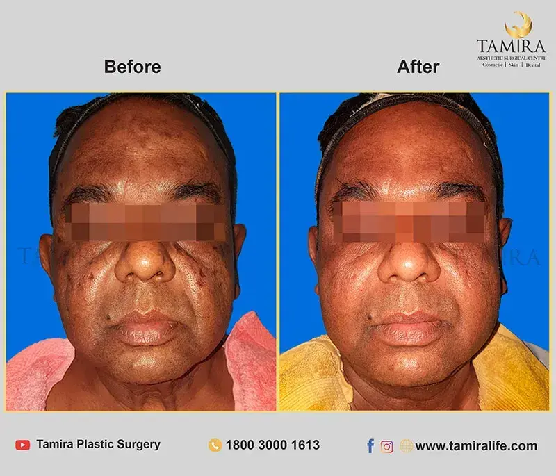Non Invasive RF Skin tightening - Thermage - Before & After