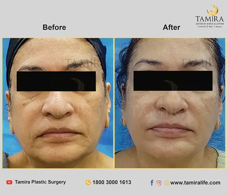 Non Invasive RF Skin tightening - Thermage - Before & After