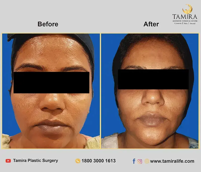 Non Invasive RF Skin tightening - Thermage - Chin - Before & After