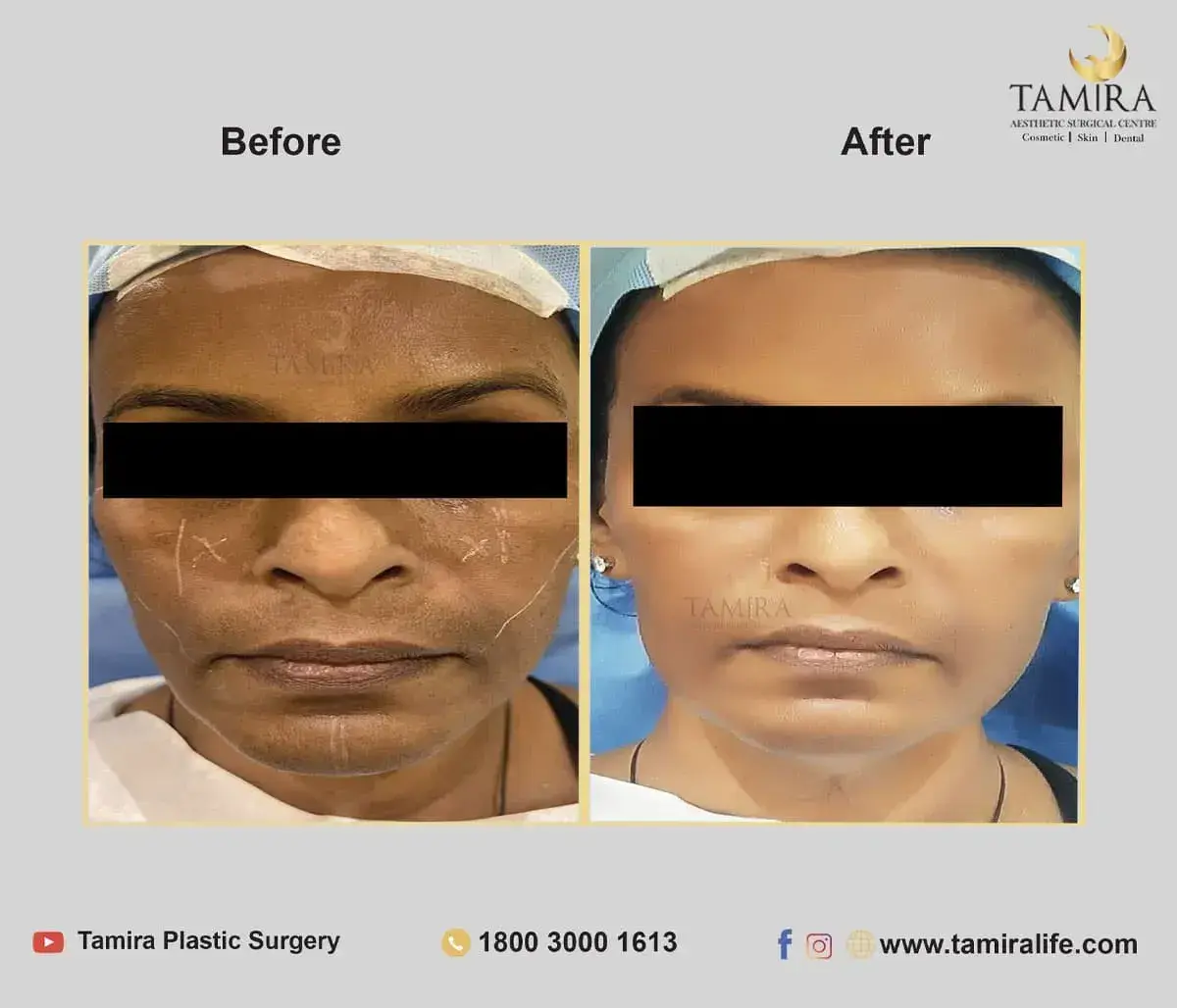 Injectables - Before & After