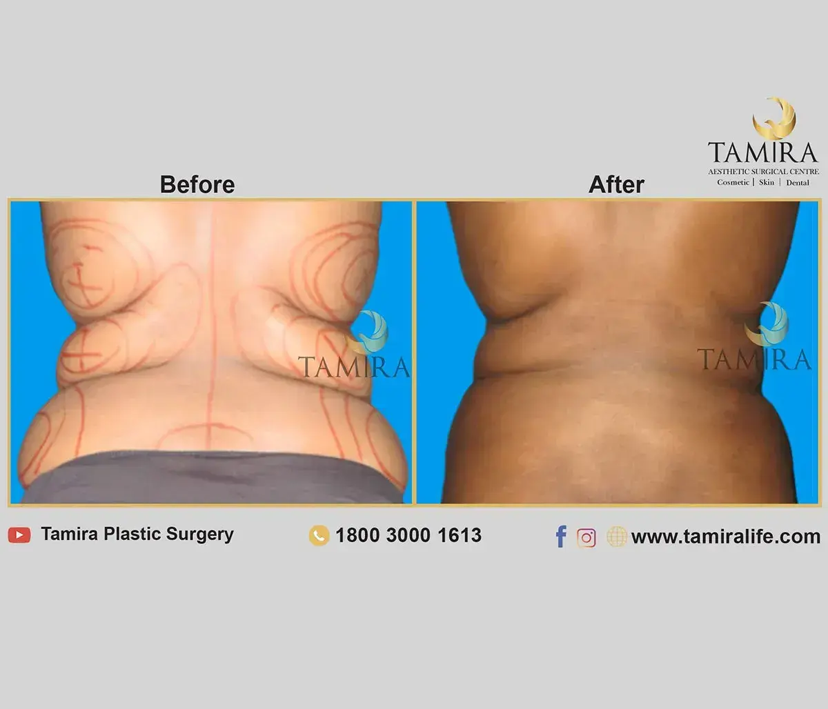 Liposuction - Flank/Sides - Before & After