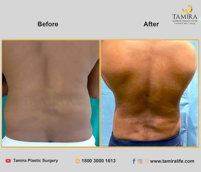 Liposuction - Flank/Sides - Before & After