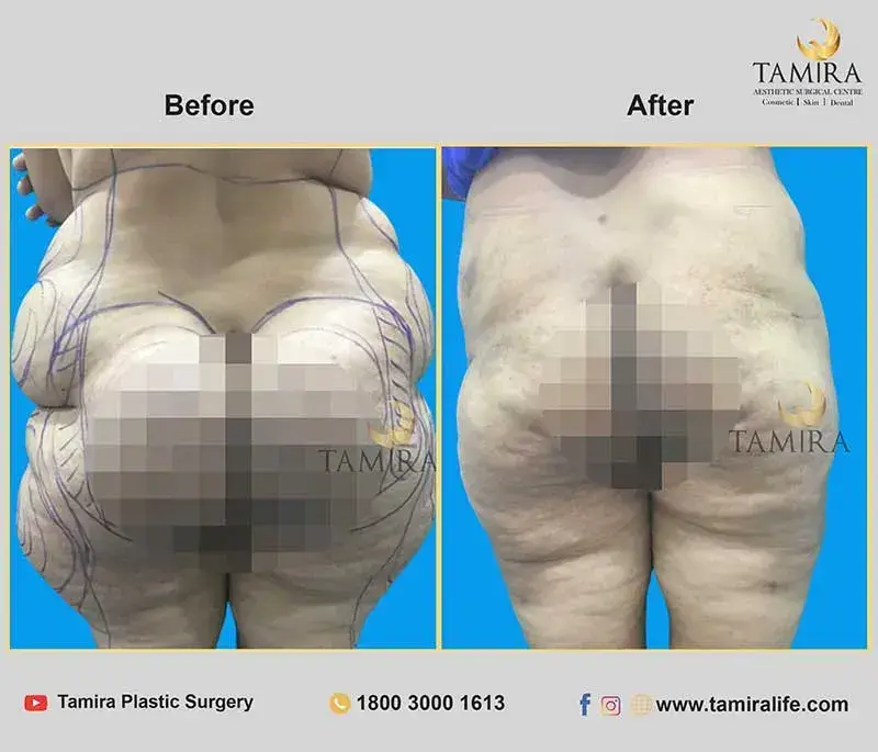 Liposuction - Buttocks - Before & After