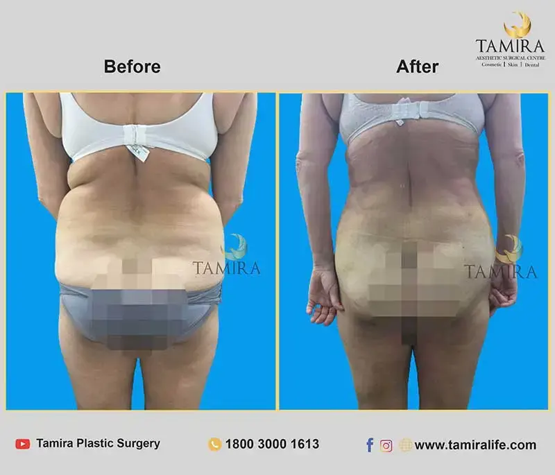 Liposuction - Buttocks - Before & After