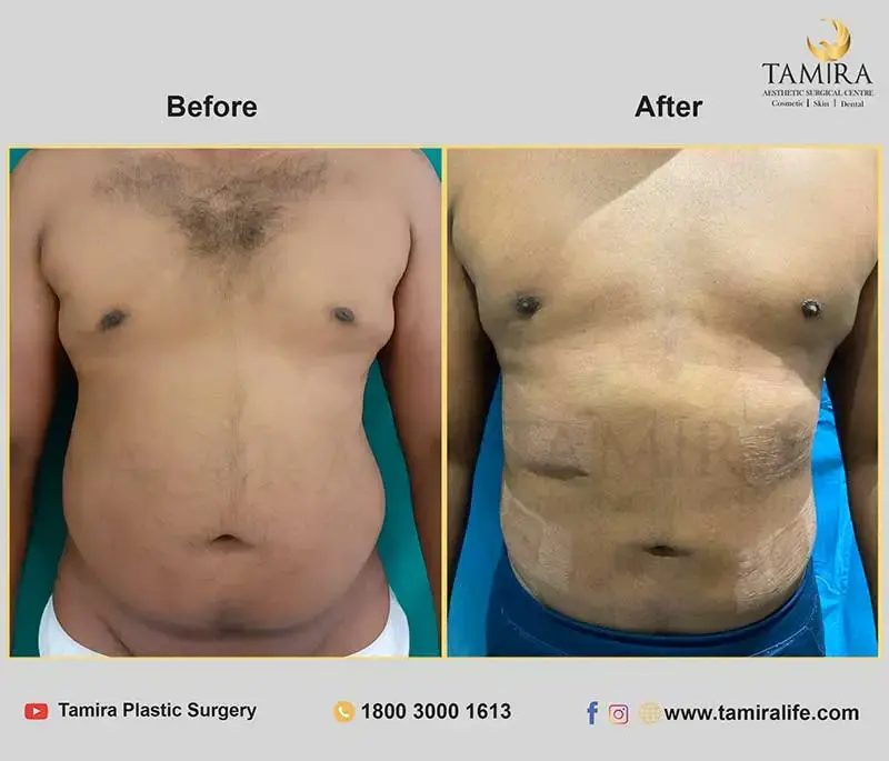 Liposuction - Abdomen - Before & After