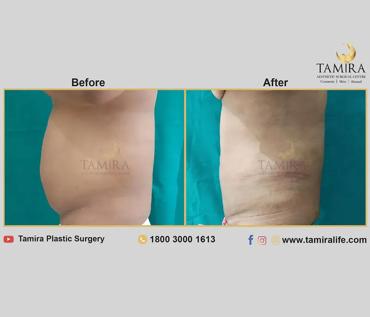Liposuction - Abdomen - Before & After