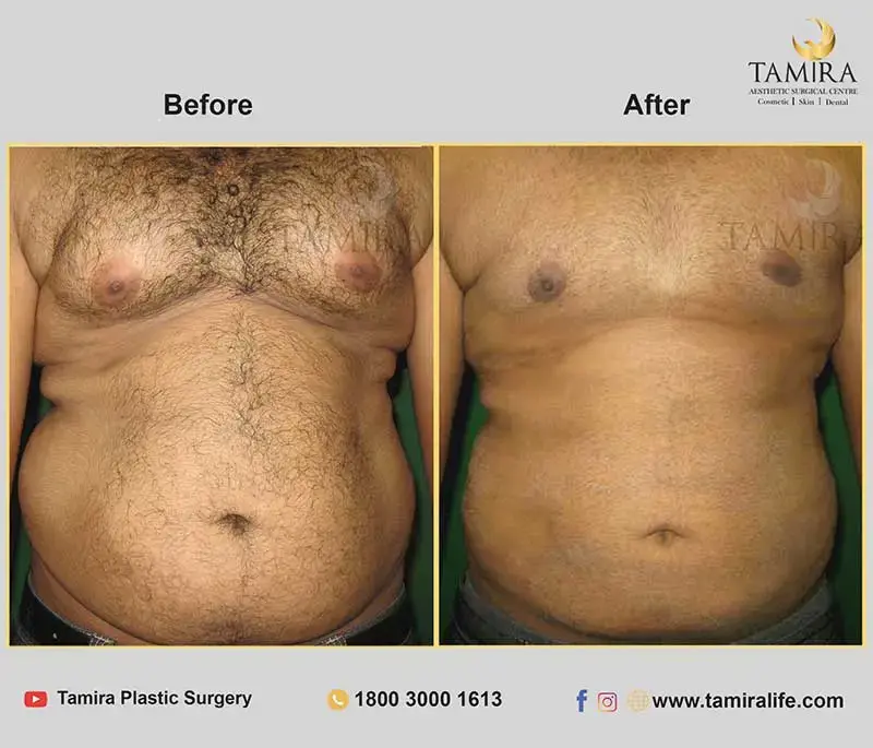 Liposuction - Abdomen - Before & After